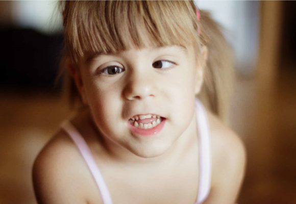 Estrabismo infantil: esotropia não acomodativa