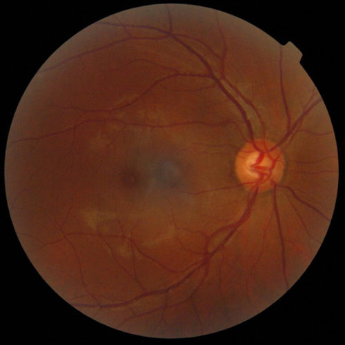 Antiangiogênicos na degeneração macular, diabetes e outras doenças da retina