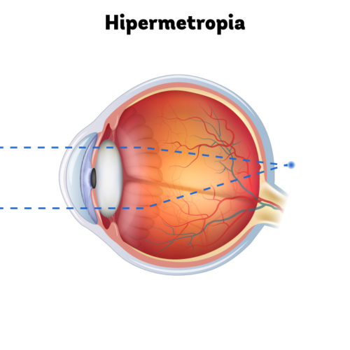 Paciente de 40 anos, com hipermetropia moderada à alta olhando para um objeto ao longe. O ponto focal está atrás da retina e os objetos parecem embaçados.