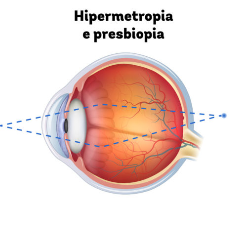 Paciente de 40 anos, com hipermetropia moderada à alta olhando para um objeto próximo. Quanto mais perto do olho, mais o ponto focal se afasta da retina e a visão se embaça.